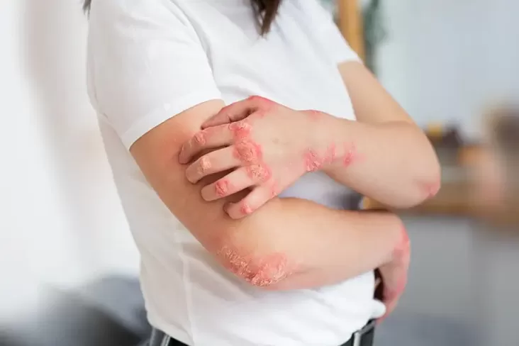 Kenali Ringworm, Penyakit Kulit yang tersebut dimaksud Belakangan Viral ke Kalangan Anggota Gym