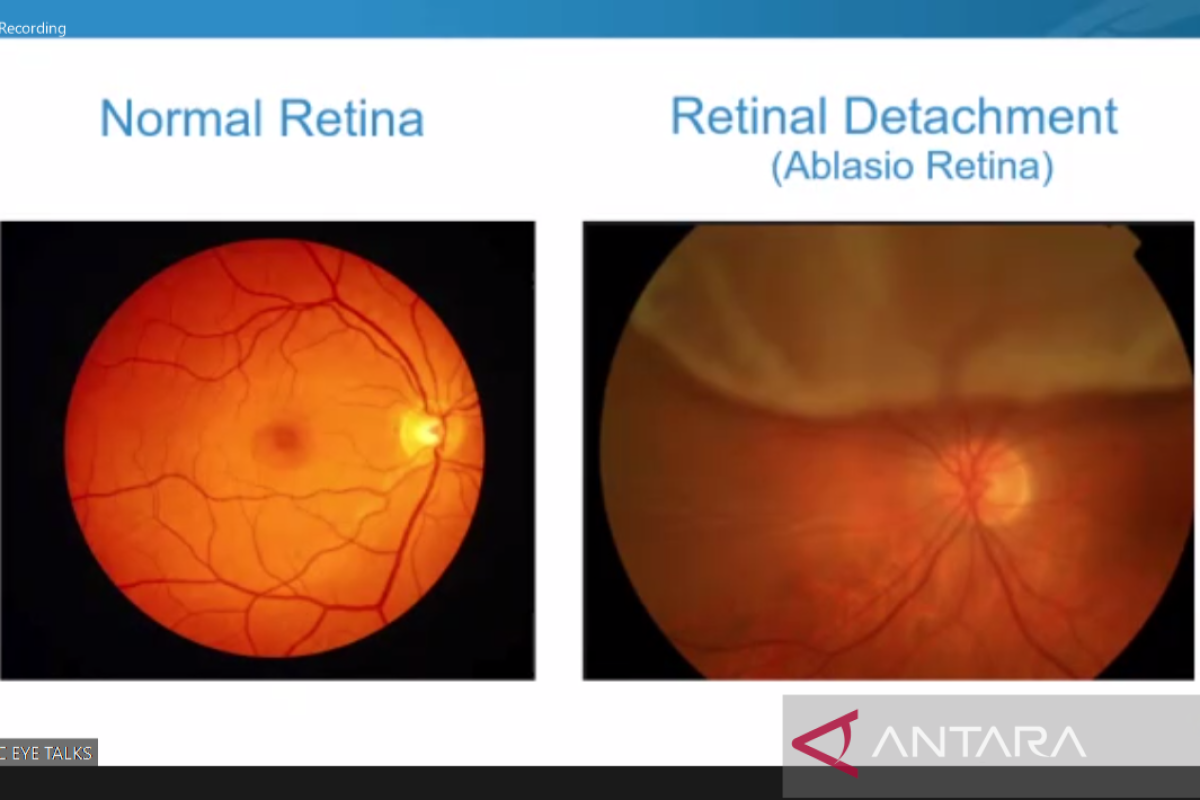 Usia 40 tahun ke berjuang melawan rentan terkena ablasio retina